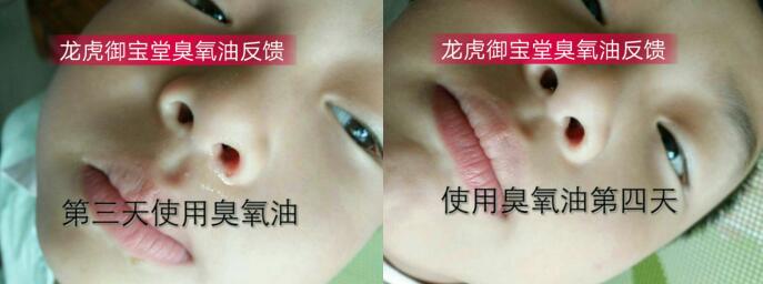 鼻孔发炎用户使用龙虎御宝堂臭氧油3天后的效果反馈