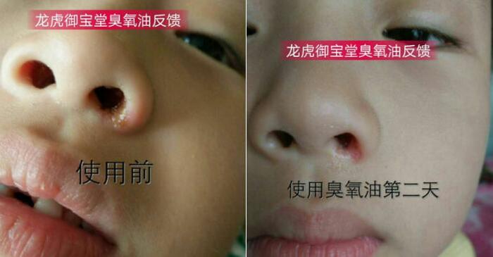 鼻孔发炎用户使用龙虎御宝堂臭氧油后的效果反馈