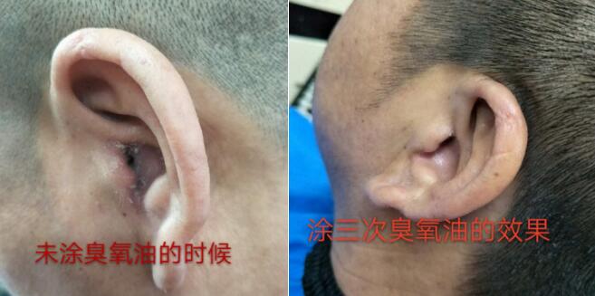 中耳炎用户使用龙虎御宝堂臭氧油一周就痊愈
