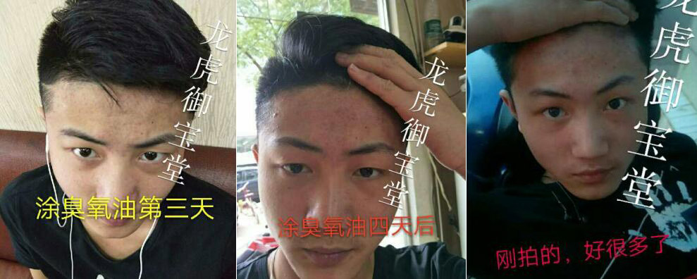 青春痘使用龙虎御宝堂臭氧油第三天第四天的效果 青春痘使用龙虎御宝堂臭氧油第三天第四天的效果