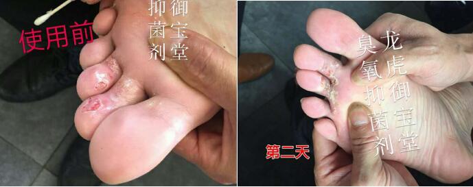 用户多年的脚气,使用龙虎御宝堂臭氧油前后效果对比