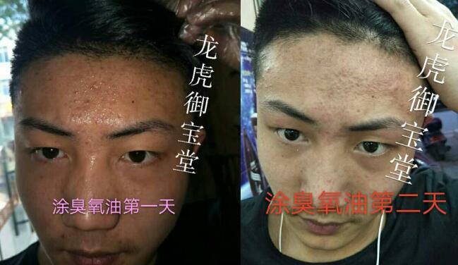 小伙青春痘使用龙虎御宝堂臭氧油后的效果对比图 小伙青春痘使用龙虎御宝堂臭氧油后的效果对比图