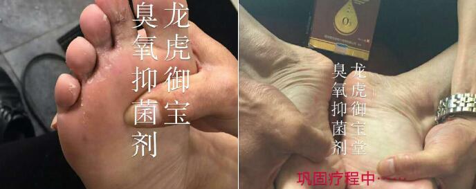 用户多年的脚气,使用龙虎御宝堂臭氧油前后效果对比