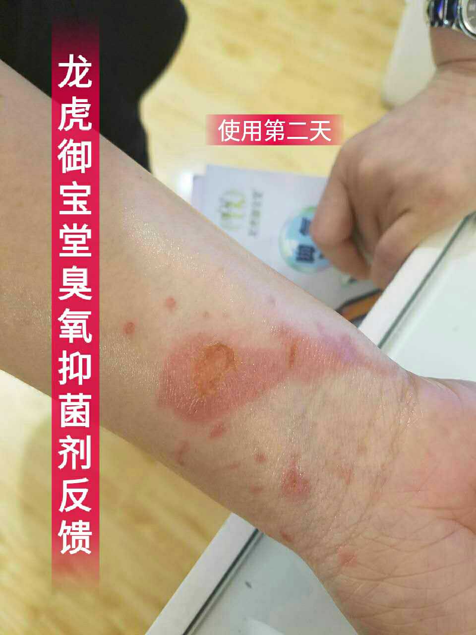 【龙虎御宝堂臭氧油烫伤案例】 用户被开水烫伤后,伤口红肿破皮,涂用