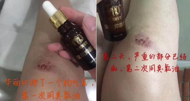 膝盖摔伤使用臭氧油后消肿且没留疤
