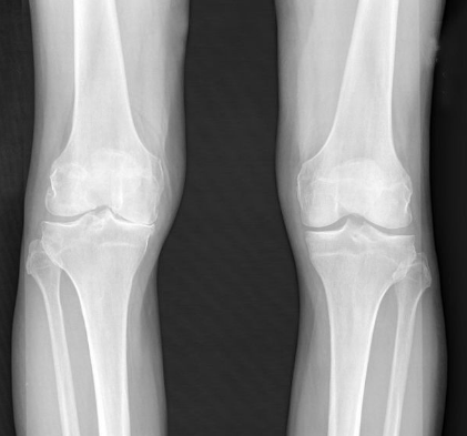 膝关节除了骨头,还有韧带,半月板,关节囊,肌肉等等等,如果只拍x光片